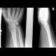 Fracture of radial styloid process and base of 5th metacarpal bone: X-ray - Plain radiograph
